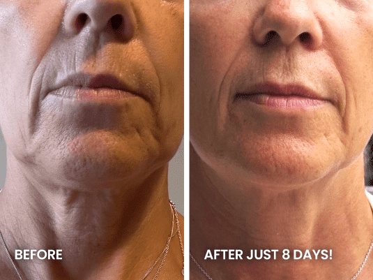 "before and after" comparison of a person's lower face and neck. The left image, labeled "BEFORE", shows more prominent wrinkles around the mouth, textured skin on the chin, and some sagging on the neck. The right image, labeled "AFTER JUST 8 DAYS!", shows noticeably smoother skin, reduced wrinkles around the mouth, and a firmer appearance on the chin and neck.