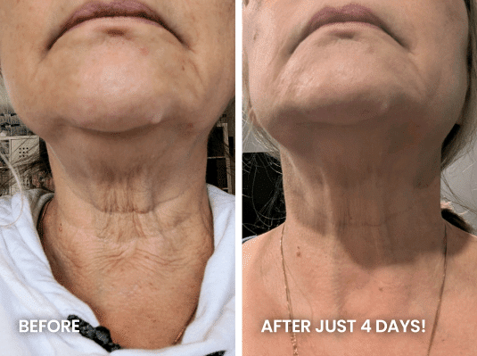 Photograph showing a person's chin and neck before and after treatment. The left panel, labeled "BEFORE", shows a neck with significant wrinkles, loose skin, and a prominent double chin. The right panel, labeled "AFTER JUST 4 DAYS!", shows the same neck with noticeably reduced wrinkles, tighter skin, and a less prominent double chin.